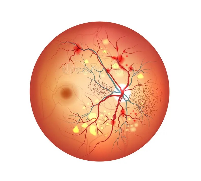 Diabetic Eye Care